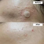 NINELESS A-Control 10% Azelaic Acid Serum - Image 6