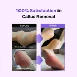 baren Callus Remover Kit for Feet: Foot File & Peeling Foot Spray - Image 8